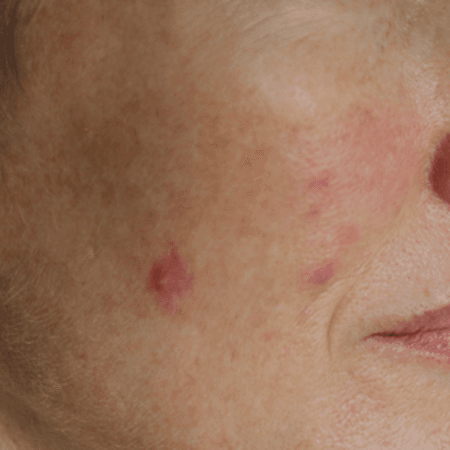 How Does HRT and Menopause Affect Our Skin?