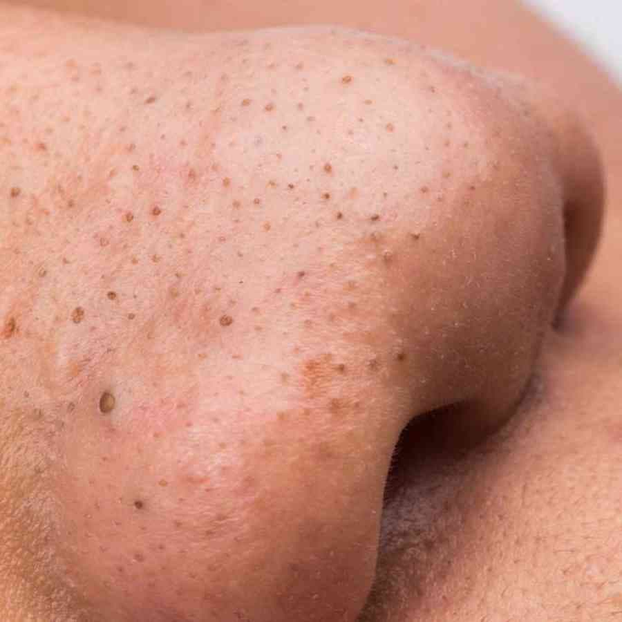 Understanding Blackheads and How to treat them