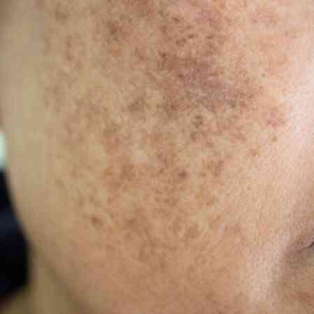 Skincare guidance for those with Melasma