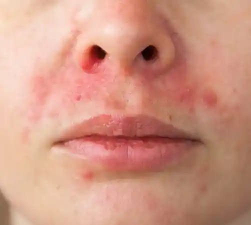 What is Peri-Oral Dermatitis?