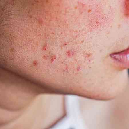 Skincare Recommendations for PCOS: A Comprehensive Guide