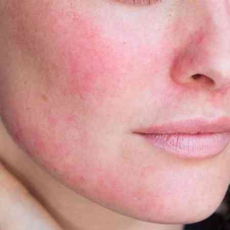 Rosacea: Triggers, Treatment, and Advice