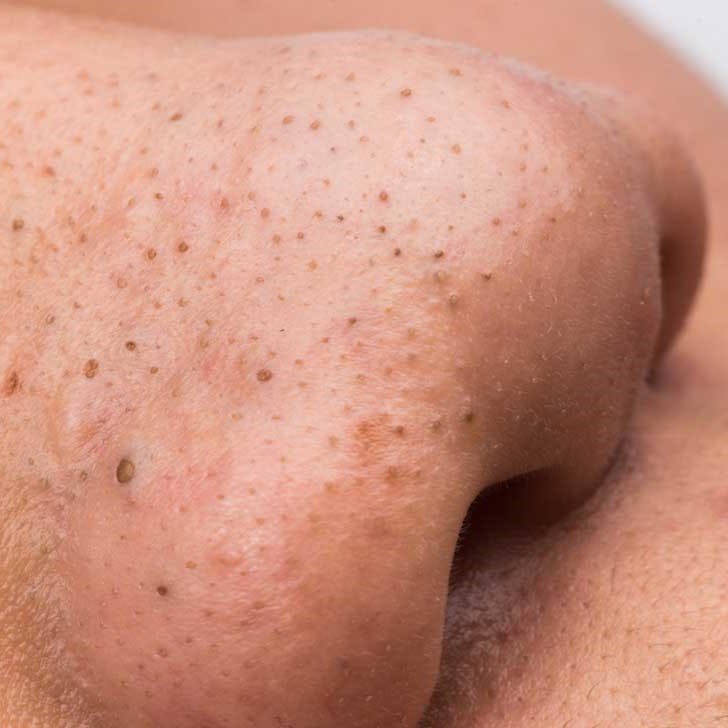 Understanding Blackheads and How to treat them