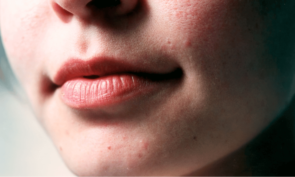 How to repair a damaged skin barrier